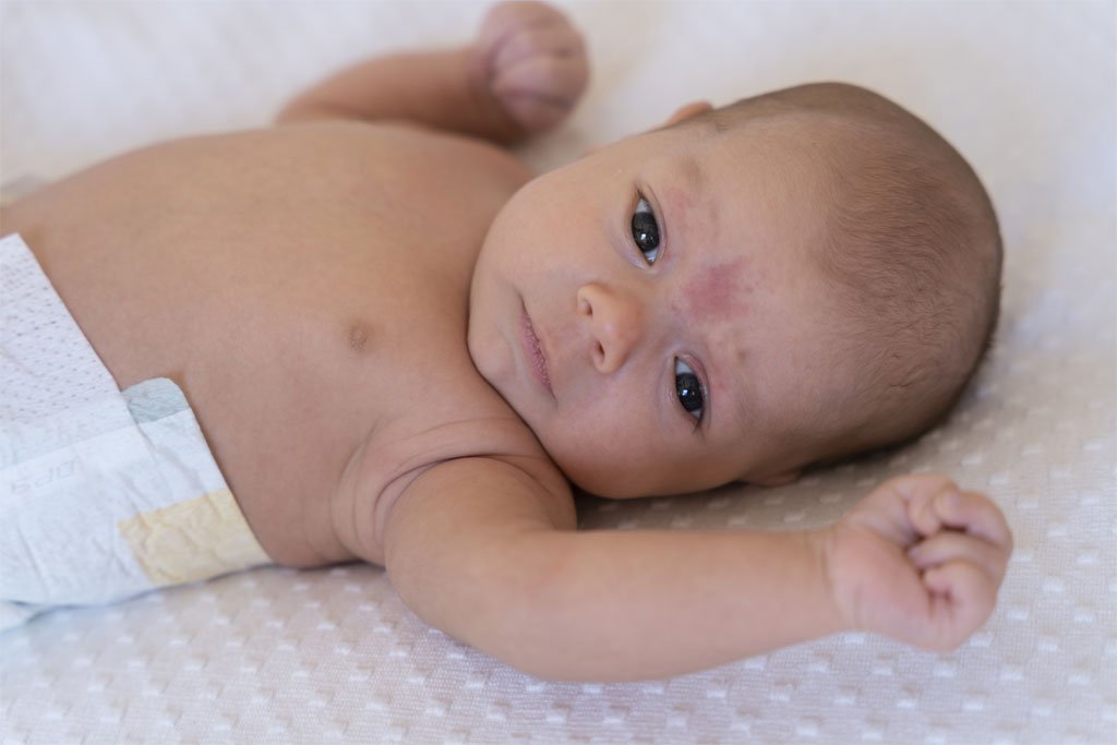 Baby receiving a chickenpox vaccination