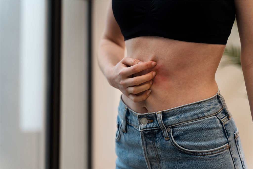 Shingles